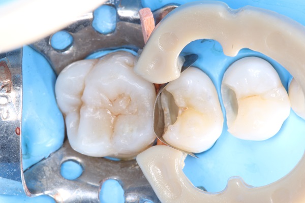 Understanding The Dental Filling Process