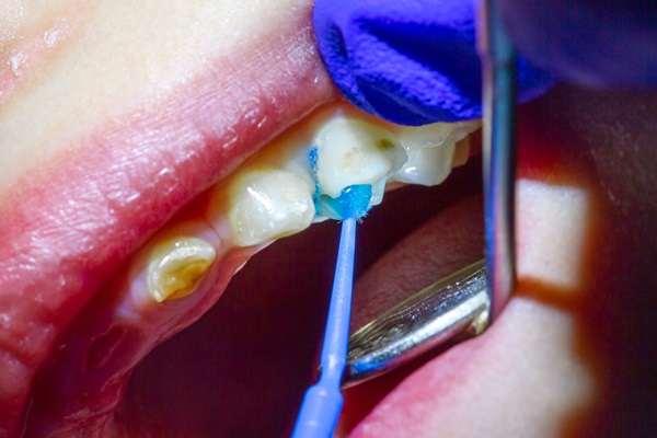 Do Dental Sealants Protect Children&#    ;s Teeth?